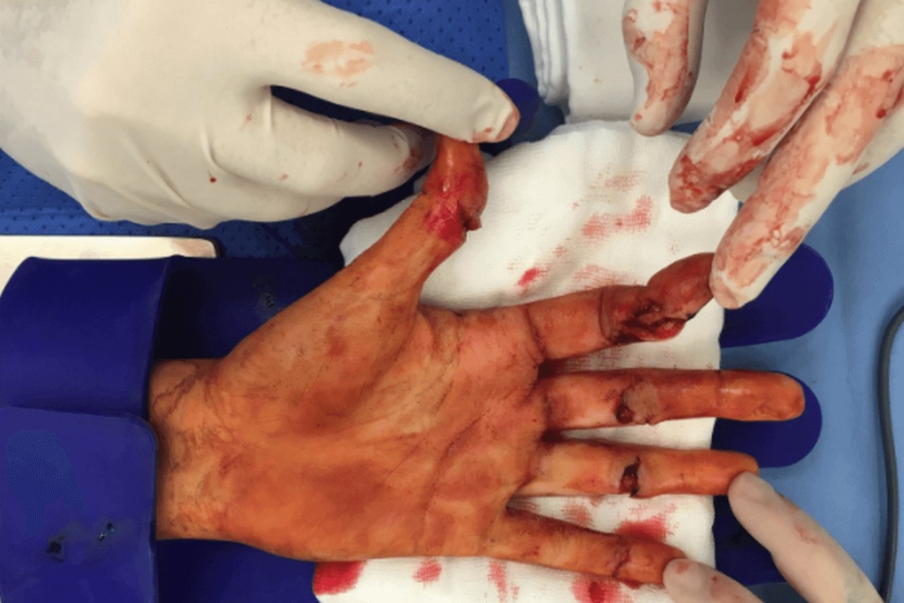 рука Квитовой после нападения 
